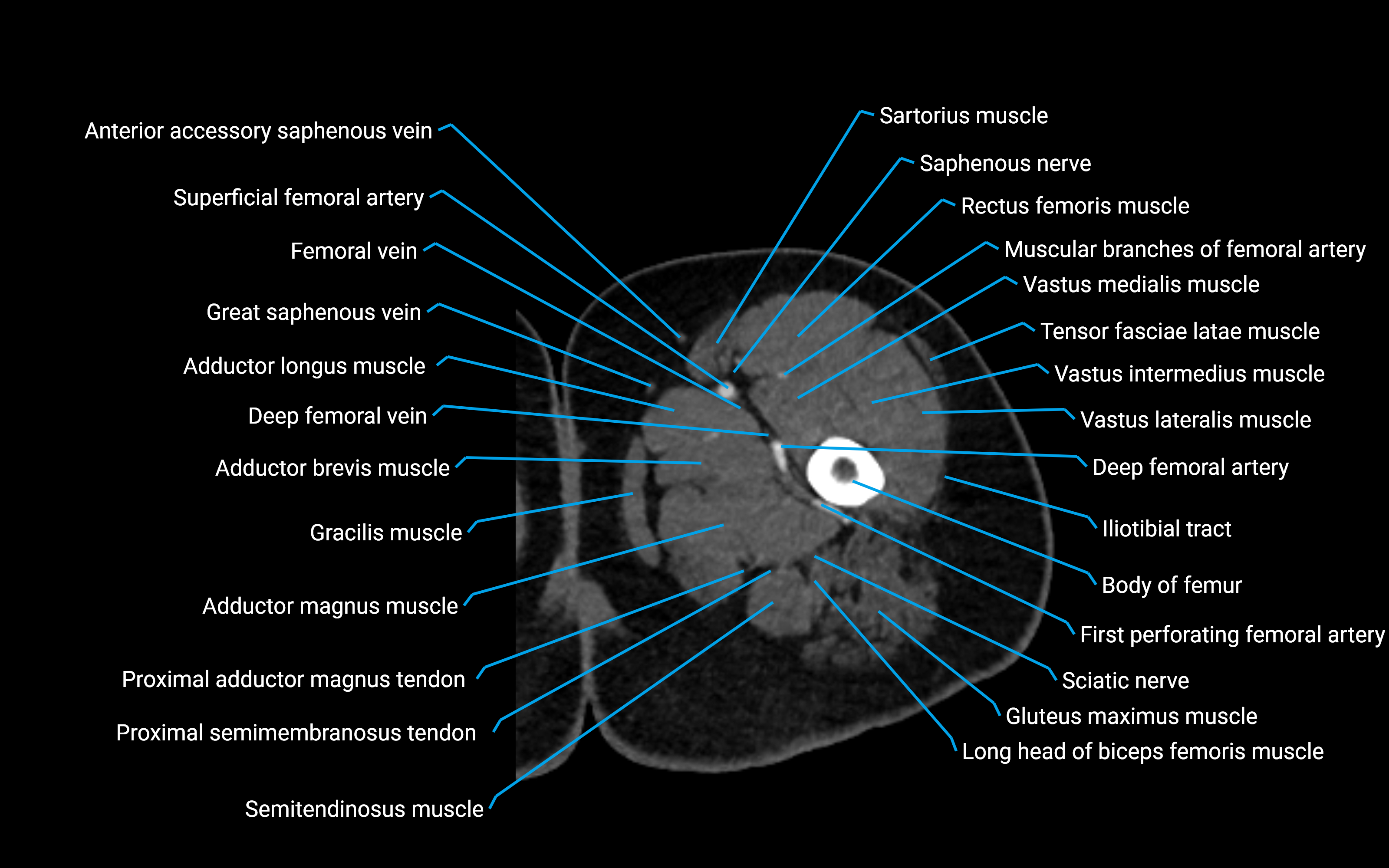 CT Hip axial cross sectional anatomy labelled image 28 (3).png